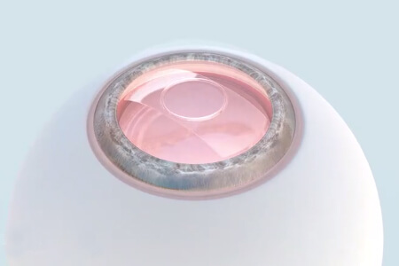 依鏡PRL晶體植入術(shù)注意事項，尤其第二步！