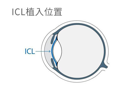 icl人工晶體植入術(shù)可以當(dāng)飛行員嗎？專家解密