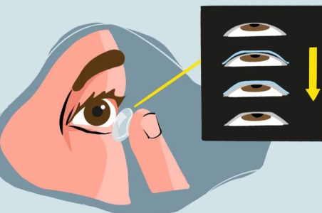 嬰兒也會(huì)得白內(nèi)障真的假的？